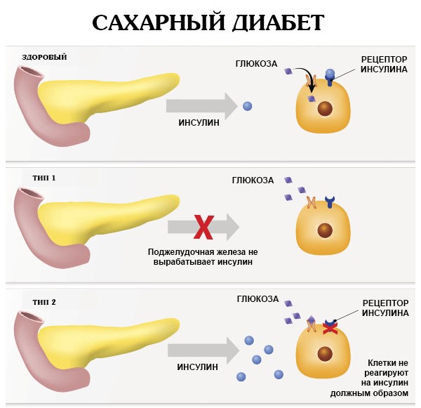 Типы сахарного диабета