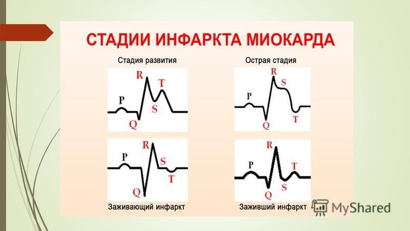 Оим это. Острая фаза инфаркта миокарда на ЭКГ. Острый инфаркт миокарда презентация. Осложнения инфаркта миокарда на ЭКГ. Острейшая стадия инфаркта миокарда ЭКГ.