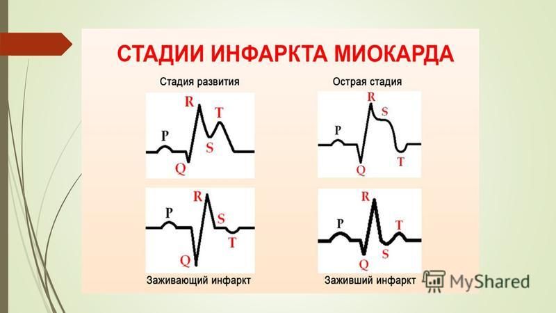 Причиной инфаркта миокарда является