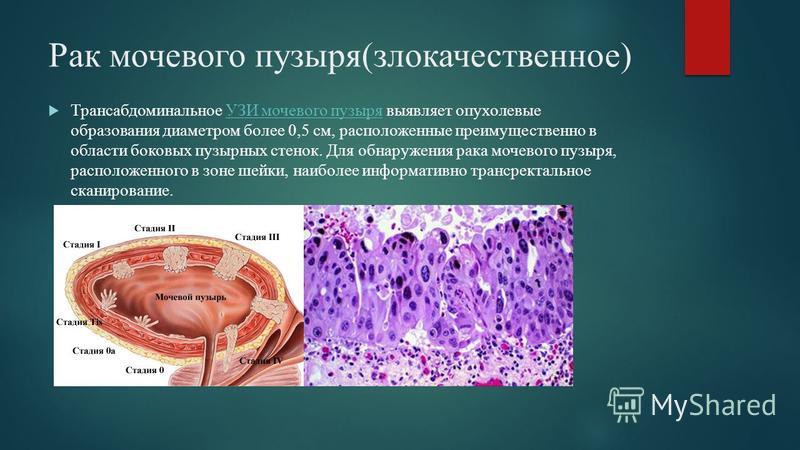 Код мкб 10 рак мочевого