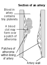 Схема поперечного сечения артерии с пятнами атеромы
