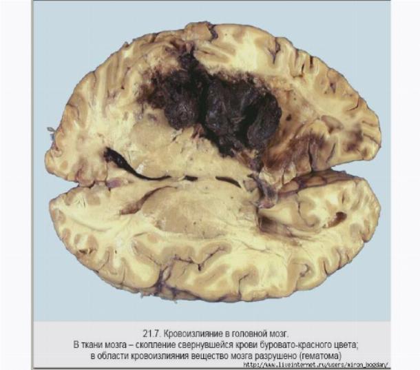 Мозге форум. Кровоизлияние в головной мозг. Обширное кровоизлияние в мозг. Обширное поражение мозга.