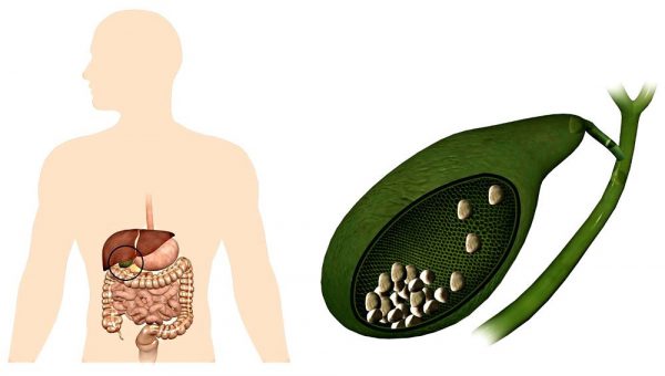 Стоит ли удалять желчный пузырь если есть камни?