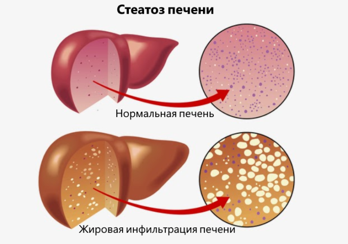 Стеатоз 