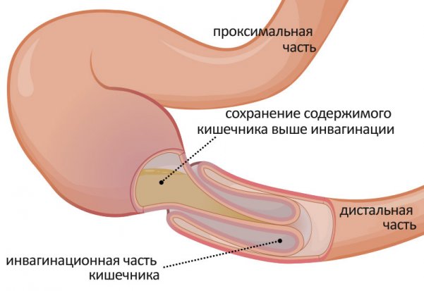 Непроходимость кишечника как осложнение асцита