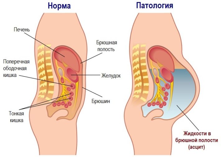 Схематическое изображение асцита