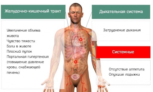 Симптомы асцита