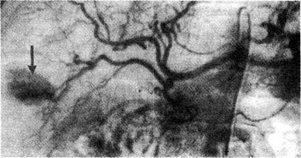 Селективная артериограмма печени
