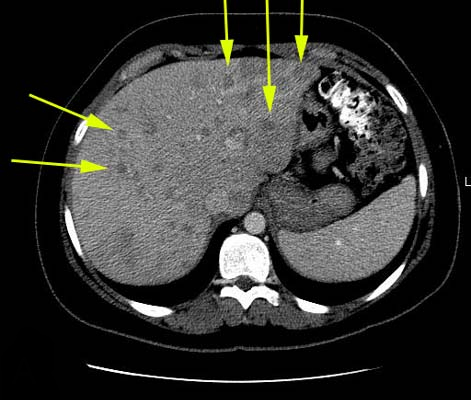 Рак печени на КТ