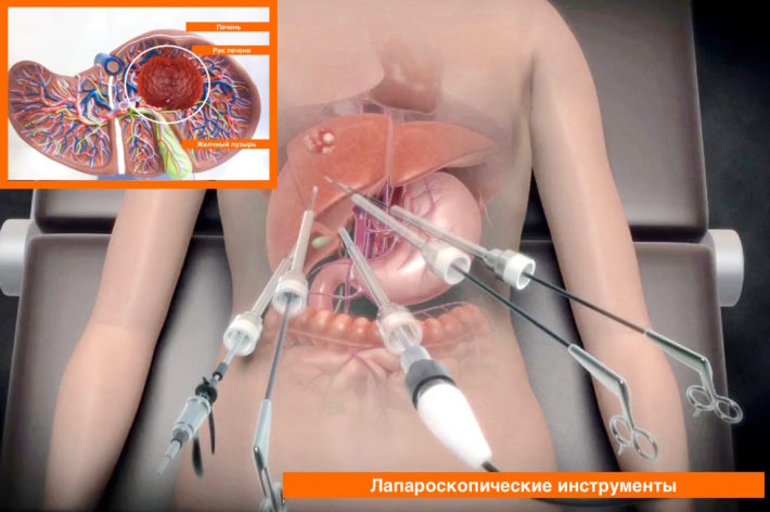 Лапароскопия при раке печени