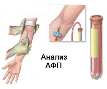 Альфа-фетопротеин