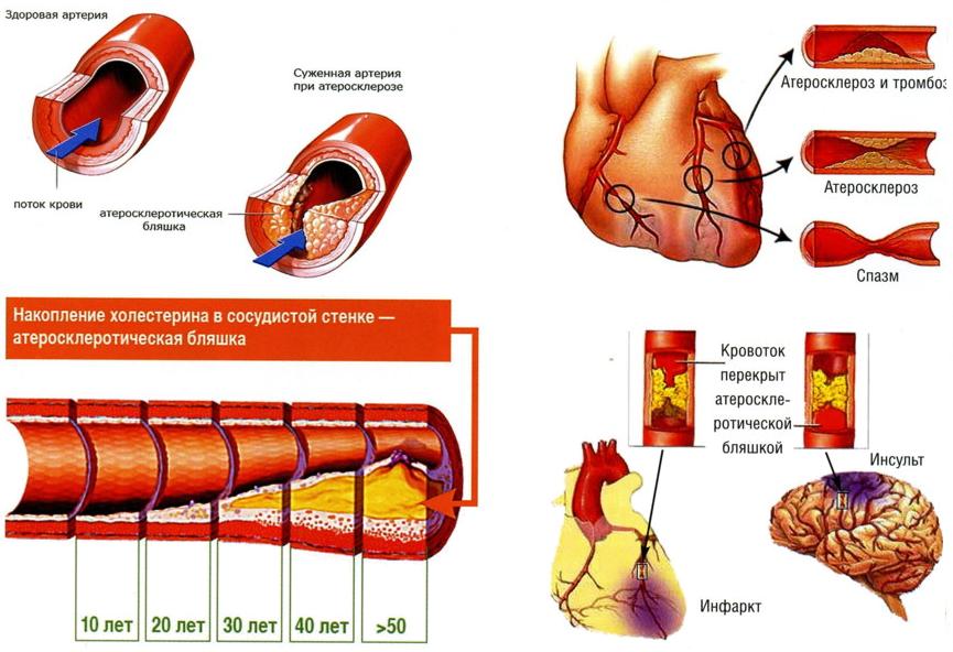 Процесс развития атеросклероза 