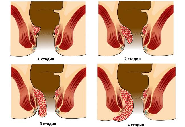 Initial hemorrhoid stages photo