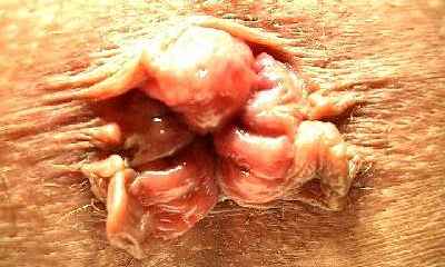 Signs and symptoms of stage 3 piles images