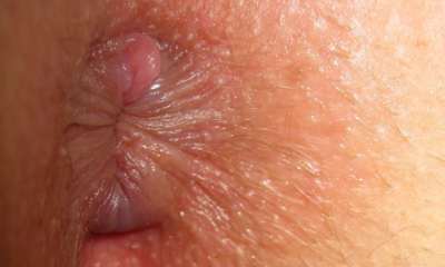 What are signs of hemorrhoids photo