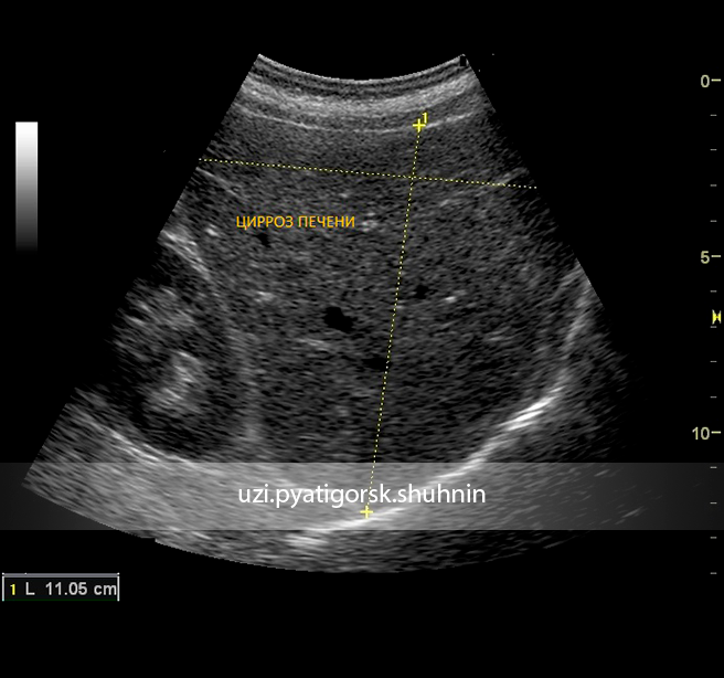 Узи брюшной полости цирроз печени