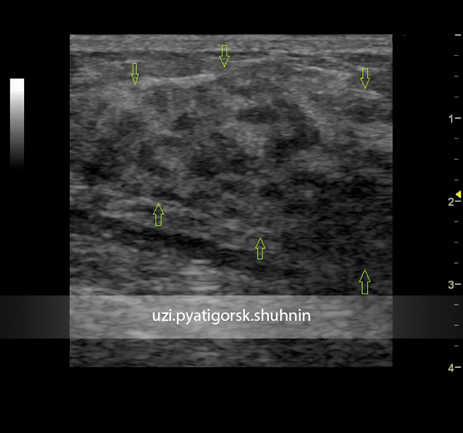 Аденоз молочной железы что это. Аденоза молочной железы УЗИ. Фиброаденоз молочной железы на УЗИ. Фиброаденома железы на УЗИ. УЗИ молочная железа аденоз.