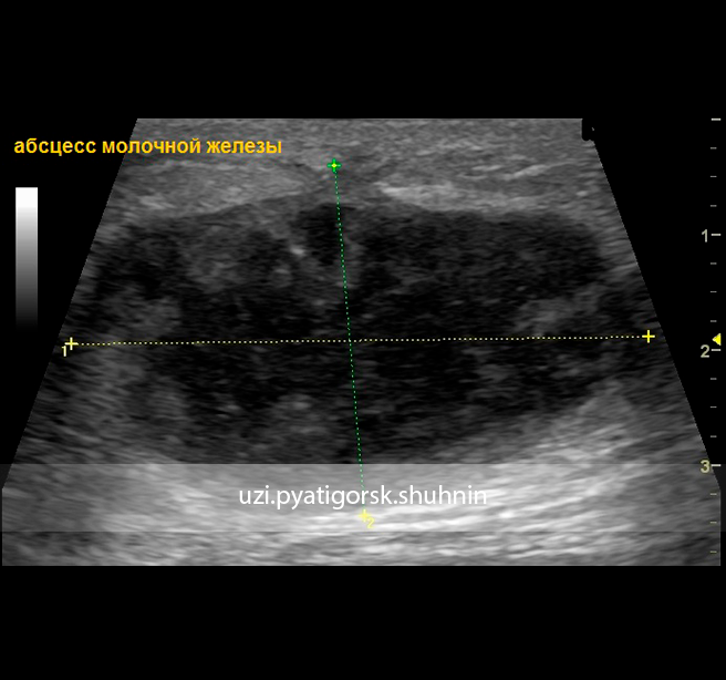 Узи молочных желез в минске