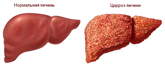 Циррроз печени