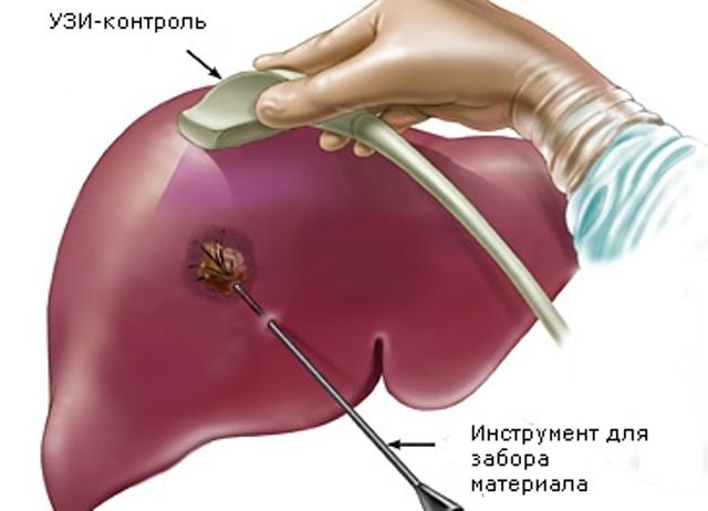 Производится пункция печени под контролем УЗИ
