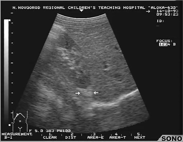 Визуализация надпочечника при УЗИ как гипоэхогенное линейное образование в виде сердца