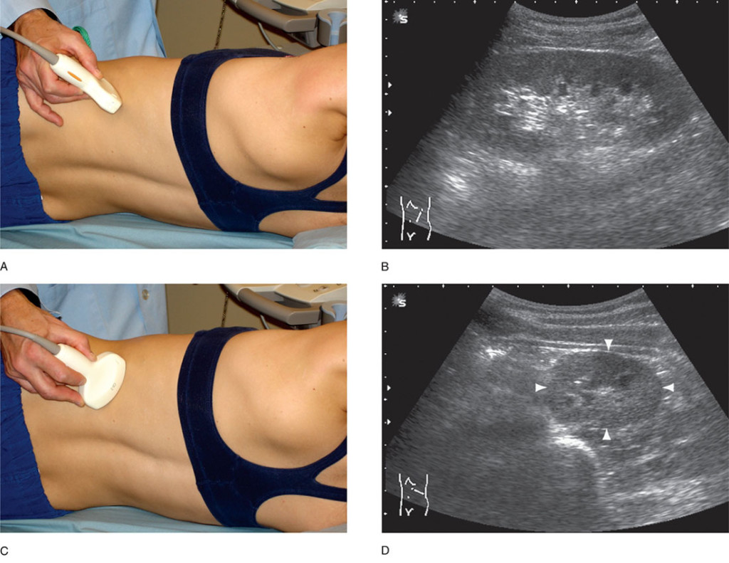 УЗИ надпочечников, при котором пациент лежит сначала на левом боку, потом на правом