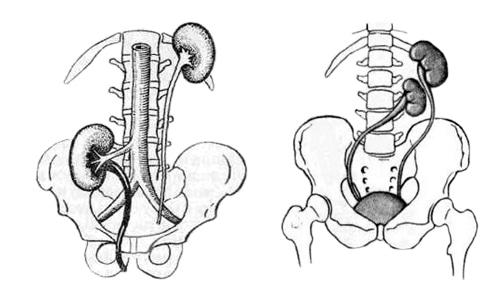 Виды дистопии почек: расположение одной почки выше другой; одностороннее расположение двух почек