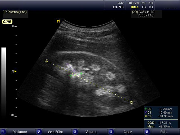 Визуализация почки при УЗИ бобовидной формы