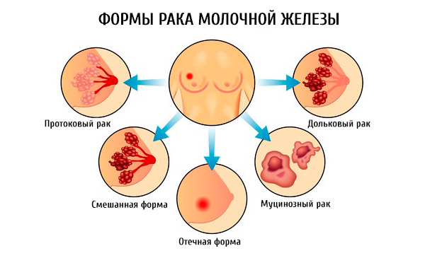 Формы рака груди