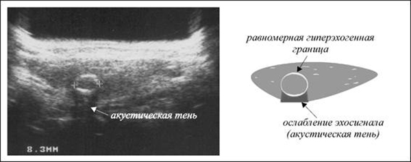 Гипоэхогенные образования