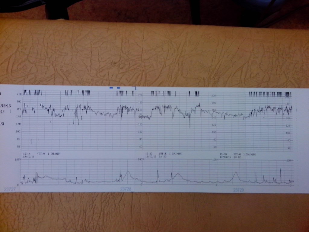 40 неделя осмотр. Норма КТГ В 40 недель беременности. Норма сердцебиения КТГ 40 недель. КТГ при беременности расшифровка 40 недель. Показатели КТГ на 40 неделе беременности норма.