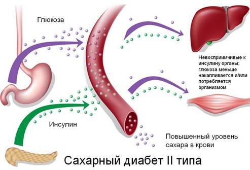 Типы сахарного диабета