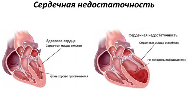 kak_lechit_serdechnuyu_nedostatochnost_2