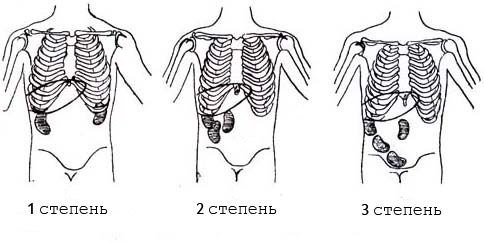 Степени нефроптоза