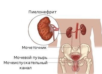 Пиелонефрит как осложнение нефроптоза