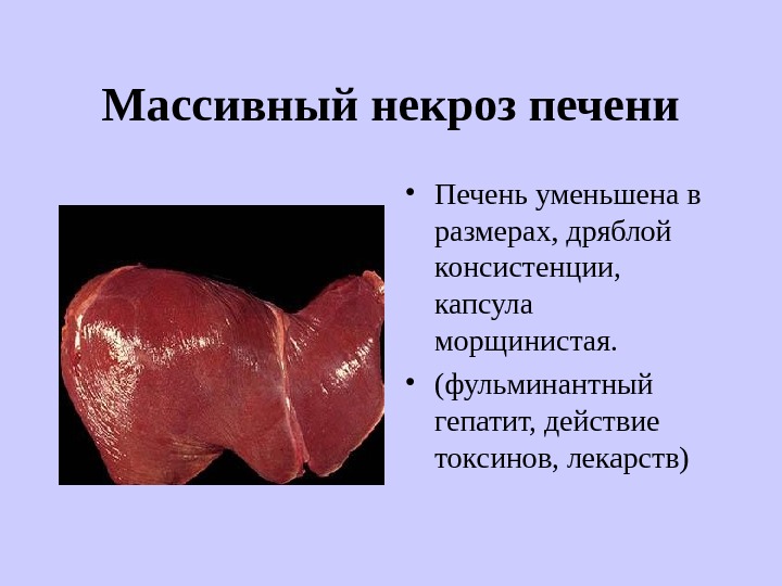 Массивный некроз печени
