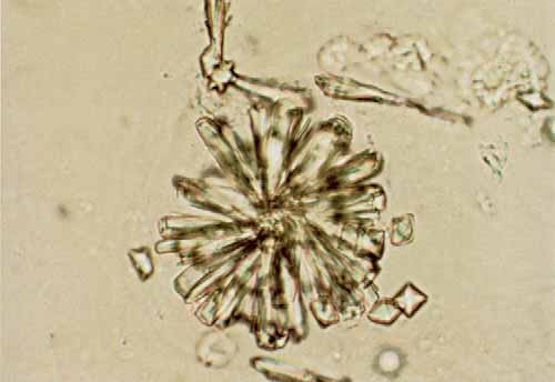 Кристаллы мочевой кислоты в моче фото под микроскопом