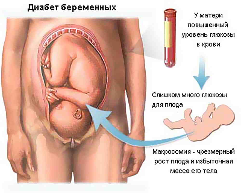 как влияет сахарный диабет на беременность