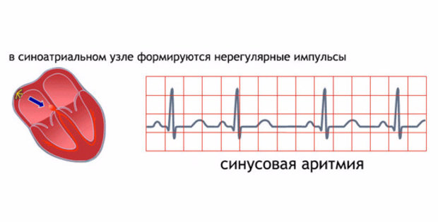 Аритмии у детей презентация