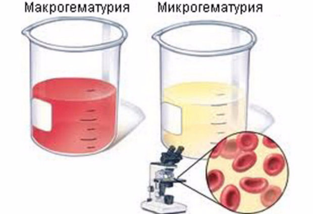 Макрогематурия