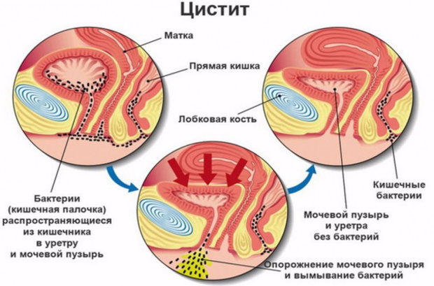 Цистит