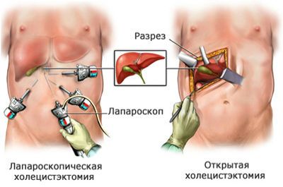 Холецистэктомия