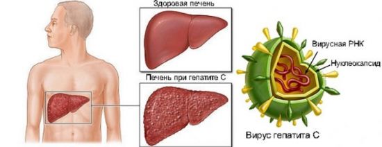 Вирусный гепатит