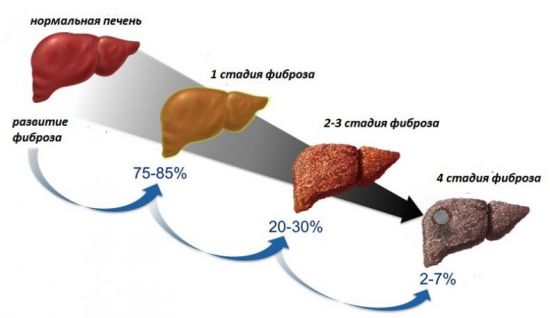 Заболевания печени