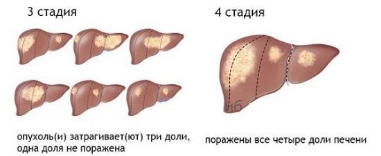 Стадии рака печени