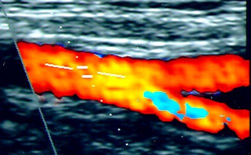 Дуплексное ультразвуковое сканирование представляет собой современный способ ультразвукового обследования, с помощью которого можно получить двухмерное изображение сосудов и определить состояние кровеносной системы, характер и скорость кровотока в нем
