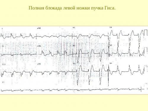 Полная блокада левой ножки пучка Гиса