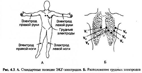 Расположение датчиков при ЭКГ