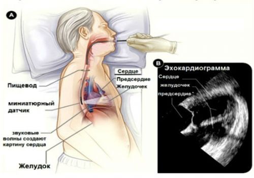 Чрезпищеводная ЭХО-КГ