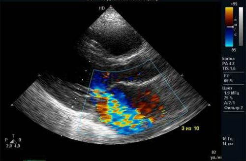 Допплерография сосудов сердца